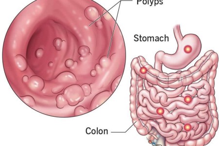 Juvenile Polyposis Syndrome (JPS)