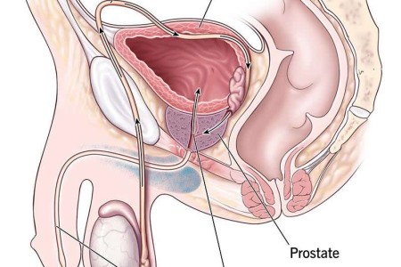 Retrograde Ejaculation