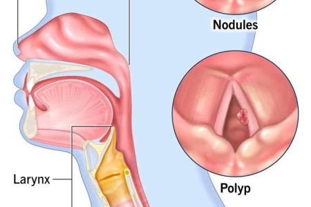Vocal Cord Lesions