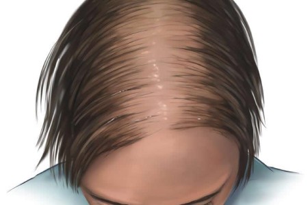 Telogen Effluvium