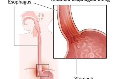 Esophagitis