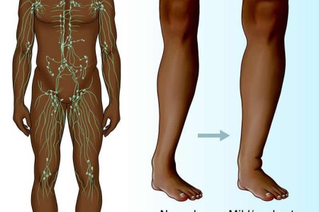 Lymphedema