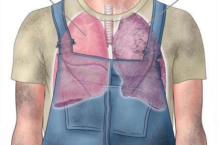 Black Lung Disease (Coal Workers’ Pneumoconiosis)