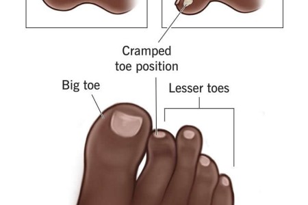 Mallet Toe