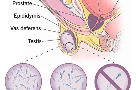 Azoospermia