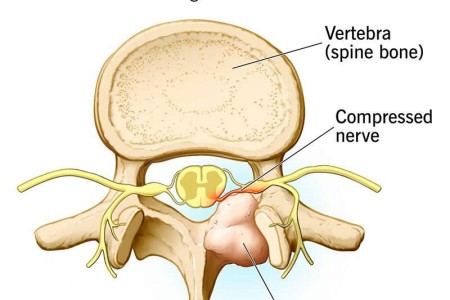 Osteoblastoma
