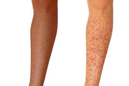 Immune Thrombocytopenia