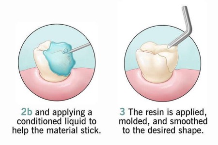 Dental Bonding
