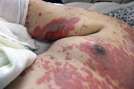 Stevens-Johnson Syndrome