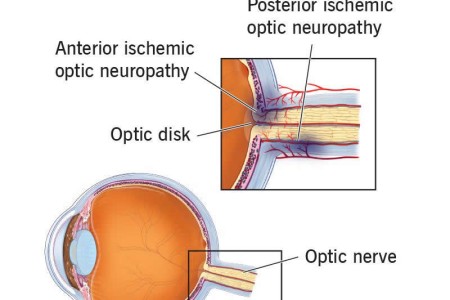 Ischemic Optic Neuropathy