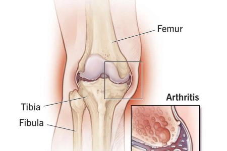 Arthritis in Knee