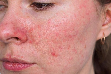 Rosacea