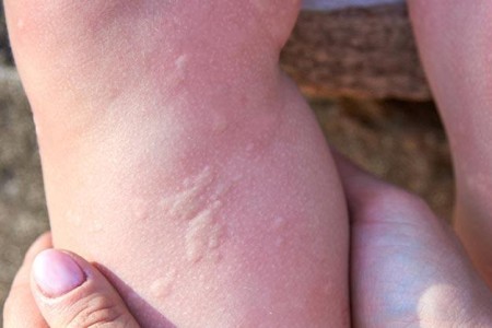 Cold Urticaria