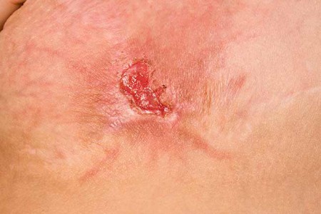 MRSA (Methicillin-resistant Staphylococcus aureus)