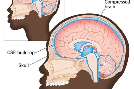 Normal Pressure Hydrocephalus (NPH)