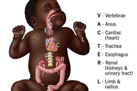 VATER Syndrome (VACTERL Association)