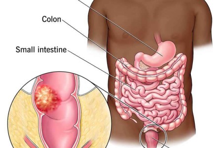 Rectal Cancer