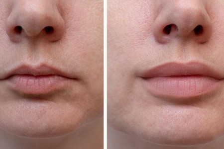Lip Fillers