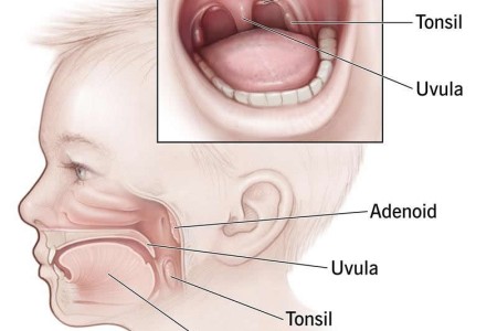 Adenoids