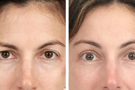 Brow Lift
