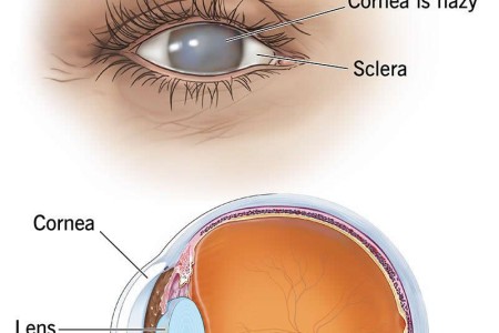 Fuchs’ Dystrophy