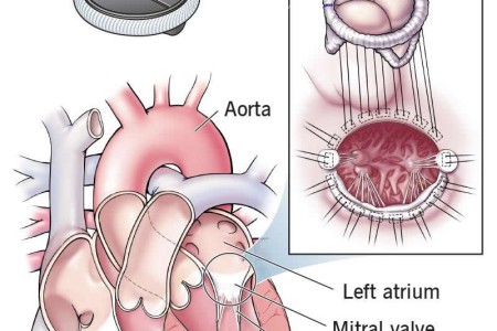Mitral Valve Replacement