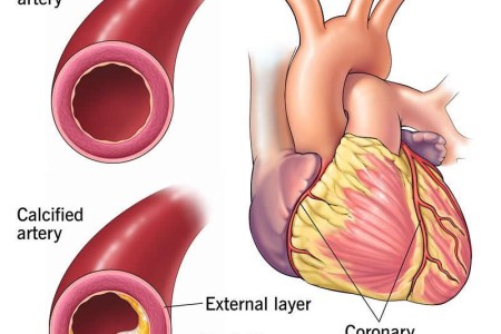 Coronary Artery Calcification