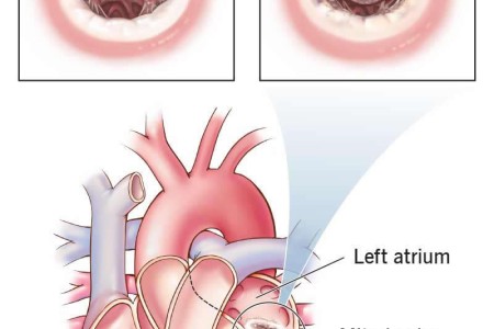 Mitral Valve Stenosis