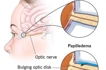 Papilledema