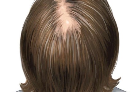 Female Pattern Baldness