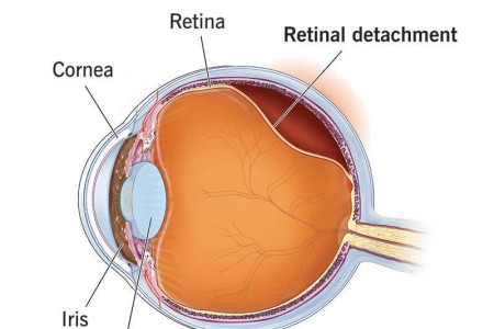Retinal Detachment