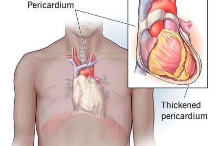 Constrictive Pericarditis