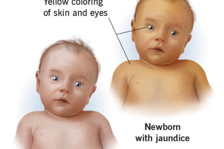 Jaundice in Newborns