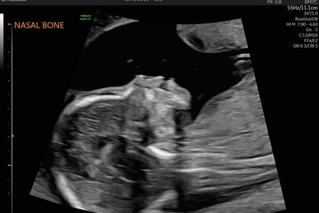 20-Week Ultrasound (Anatomy Scan)
