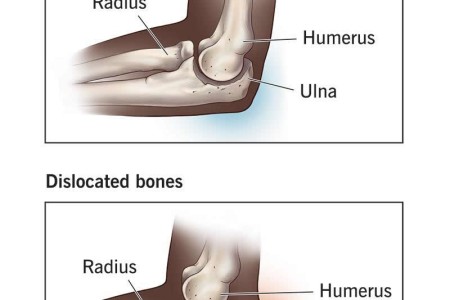 Dislocated Elbow
