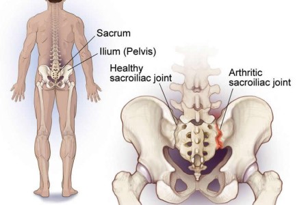 Sacroiliitis