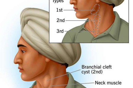 Branchial Cleft Cyst