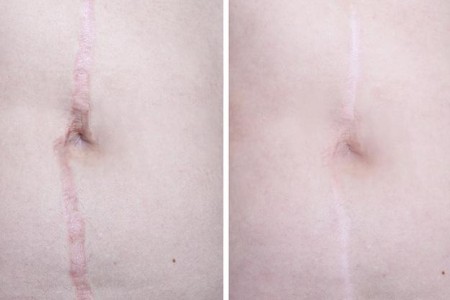 Scar Revision