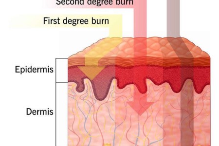 Sunburn