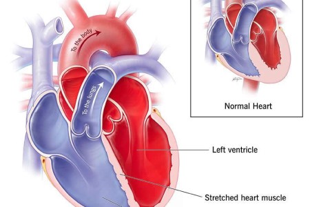 Alcohol-Induced Cardiomyopathy