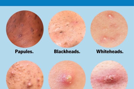 Pimples
