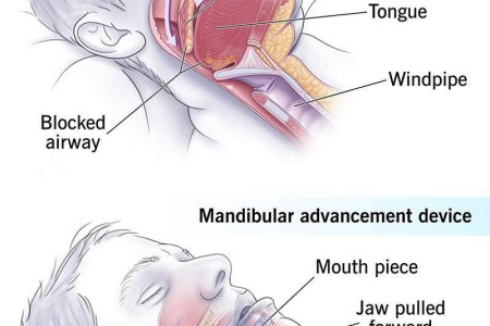 Oral Appliances for Sleep Apnea