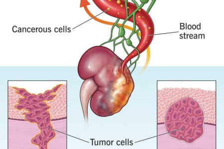 Tumor