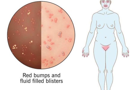 Herpes Simplex Virus (HSV)