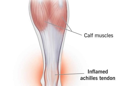 Achilles Tendinitis
