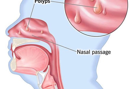 Nasal Polyps