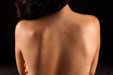 Back Acne