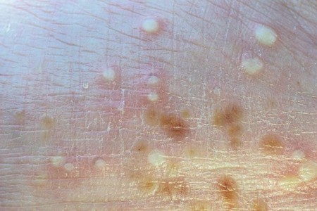 Pustular Psoriasis