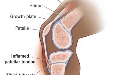 Osgood-Schlatter Disease