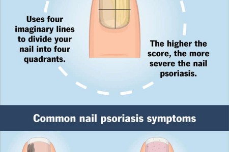 Nail Psoriasis